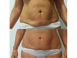 Lipolaser prima e dopo