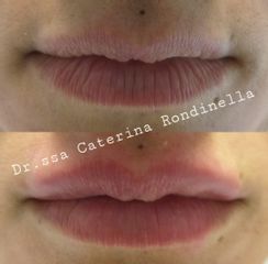 Filler labbra - Dott.ssa Caterina Rondinella