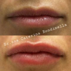 Filler labbra - Dott.ssa Caterina Rondinella