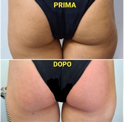 Exilis Elite - Dott.ssa Caterina Rondinella