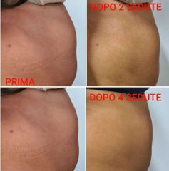 Laserlipolisi - Dott.ssa Caterina Rondinella