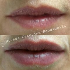 Acido ialuronico - Dott.ssa Caterina Rondinella