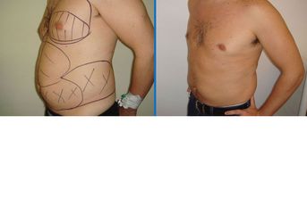 Liposuzione prima e dopo