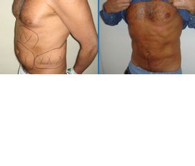 Liposuzione prima e dopo