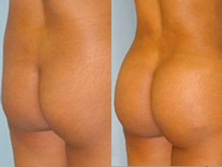 Gluteoplastica prima e dopo