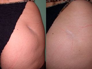 lipofilling glutei prima e dopo
