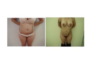 pre e post liposuzione