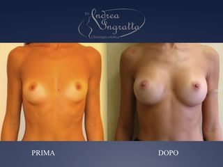 Mastoplastica additiva prima e dopo
