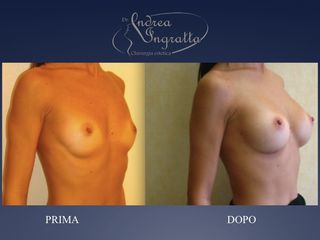 Mastoplastica additiva prima e dopo