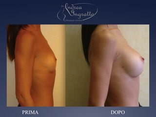 Mastoplastica additiva prima e dopo