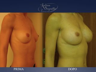 Mastoplastica additiva prima e dopo