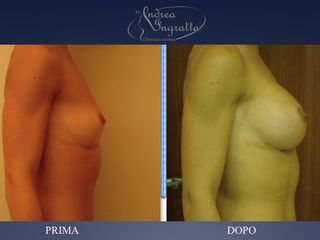 Mastoplastica additiva prima e dopo