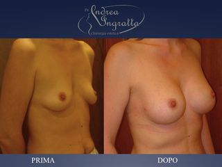 Mastoplastica additiva prima e dopo