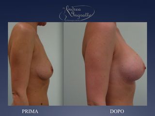 Mastoplastica additiva prima e dopo