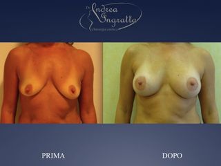 Mastopessi Additiva prima e dopo