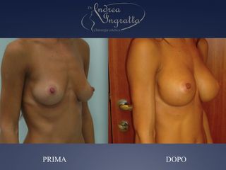 Mastoplastica additiva prima e dopo