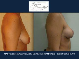 Mastopessi prima e dopo