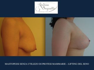 Mastopessi prima e dopo