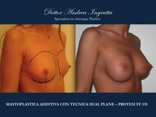 Mastoplastica additiva prima e dopo