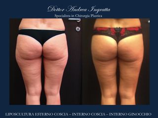 Liposcultura prima e dopo