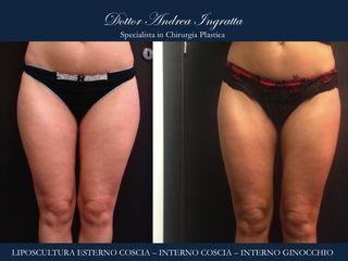 Liposcultura prima e dopo