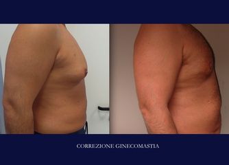 Ginecomastia prima e dopo