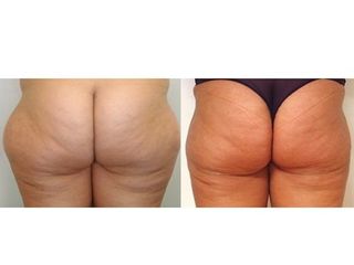 Liposcultura prima e dopo