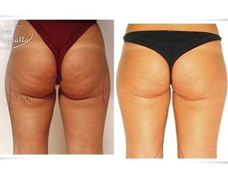 Liposcultura prima e dopo