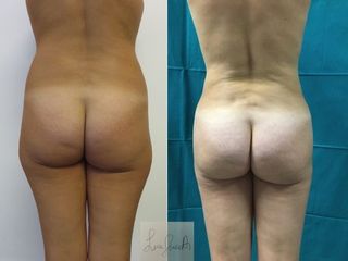 Liposcultura prima e dopo