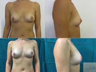 Lipofilling prima e dopo