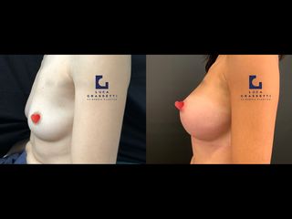 Mastoplastica additiva prima e dopo