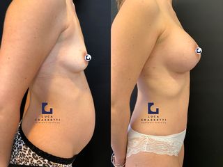 Mommy makeover prima e dopo