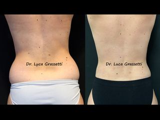 liposuzione fianchi prima e dopo