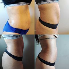 Criolipolisi - Skin Laser Clinic
