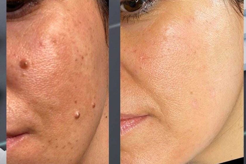 Verruche prima e dopo - 827536