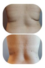 Criolipolisi - Skin Laser Clinic