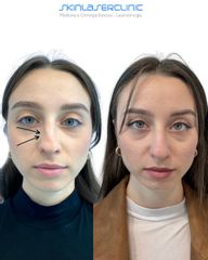 Skin Laser Clinic Rinofiller
