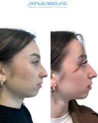 Skin Laser Clinic Rinofiller