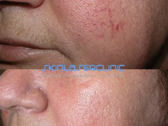 Laserterapia prima e dopo - 880440