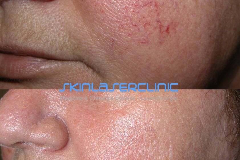 Laserterapia prima e dopo - 880440
