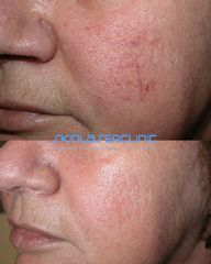 Skin Laser Clinic Teleangectasie