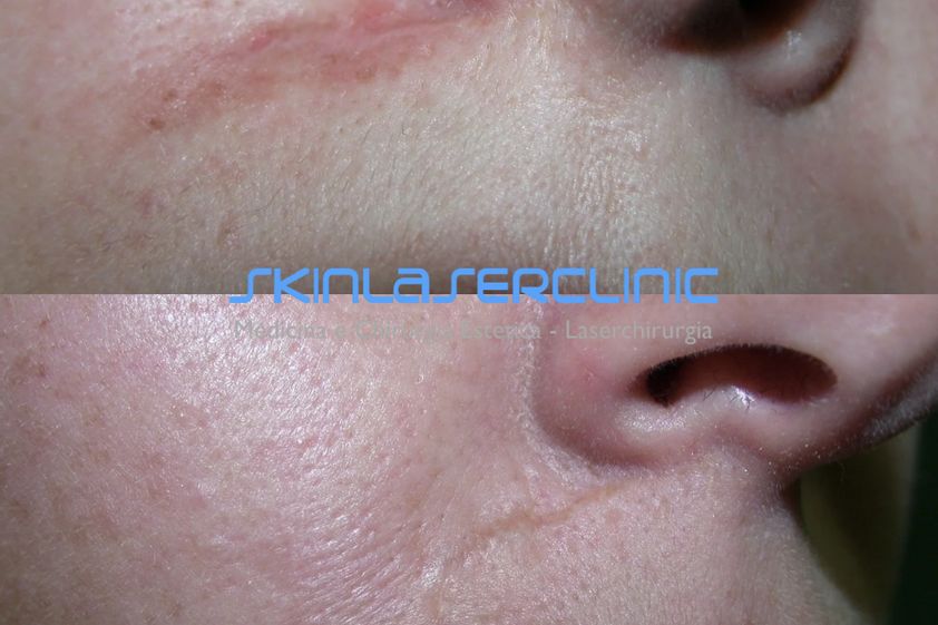 Laser CO2 frazionato prima e dopo - 880441