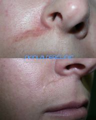 Skin Laser Clinic Cicatrice