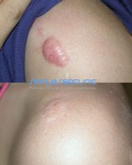 Skin Laser Clinic Cheloide telangectasico
