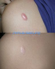 Skin Laser Clinic Cheloide teleangectasico