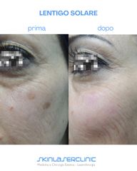 Skin Laser Clinic Lentigo solari