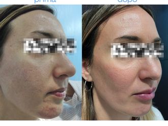 Acne prima e dopo - 880445