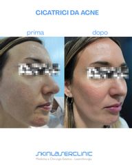 Skin Laser Clinic Cicatrici da acne