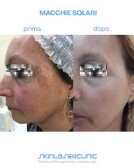 Skin Laser Clinic Lentigo solari