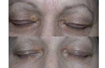 Skin Laser Clinic Xantelasmi
